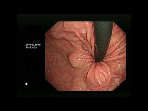 Videó: Bőrrák (Adenocarcinoma) Macskáknál