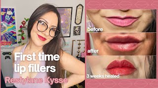 I Got Restylane Kysse Lip Filler & Instantly Regretted It?