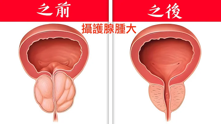 攝護腺腫大(前列腺腫大)，每天喝一杯飲料,自然療法,柏格醫生 Dr Berg - 天天要聞