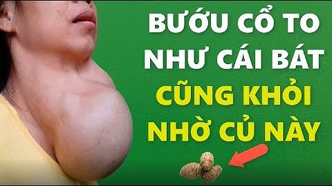 Bướu cổ to như cái bát cũng khỏi hoàn toàn nhờ loại củ có đầy ở việt nam hút độc cực tốt này