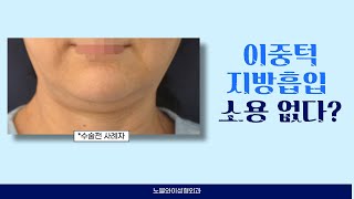 늘어진 턱살, 이중턱 문제는 지방흡입 해도 개선이 안된다?(★더보기란 필독★)