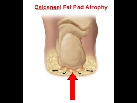 Calcaneal fat pad atrophy-What is it and what does it look like?
