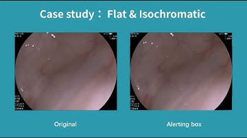 Real-Time Polyp Detection AI For Flat & Isochromatic Cases