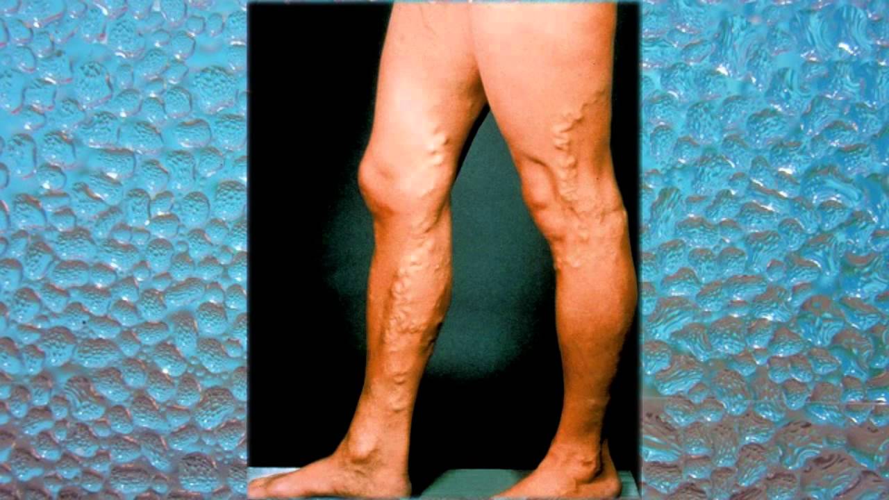 лечение варикозного расширения вен нижних - YouTube