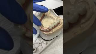 Cementing a 7-Star for tricky Implant Locations