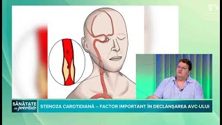 De ce apare stenoza carotidiana & ce presupune tratamentul chirurgical - Dr Calin Popa