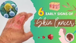 Protect Yourself: Recognizing 6 Early Warning Signs of Skin Cancer|| Cancer Awareness