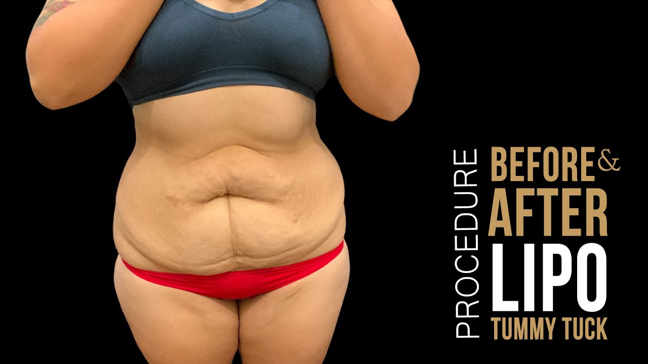 Flanks Liposuction  Before and After Photos - Palm Clinic