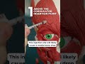 Injection points for frown lines