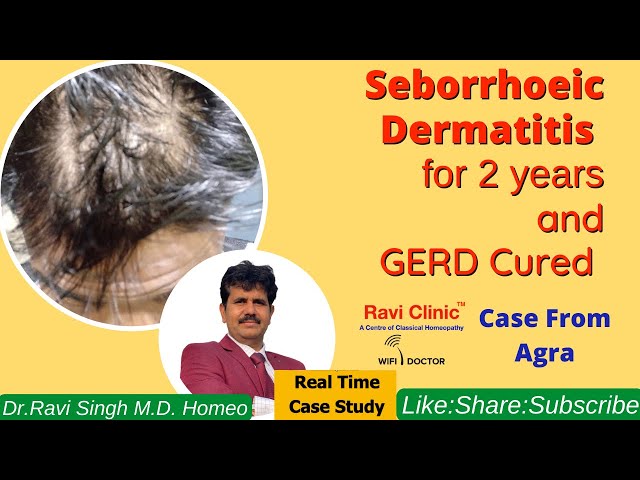Seborrhoeic Dermatitis for 2 Years and GERD for 4 years cured   Dr Ravi Singh