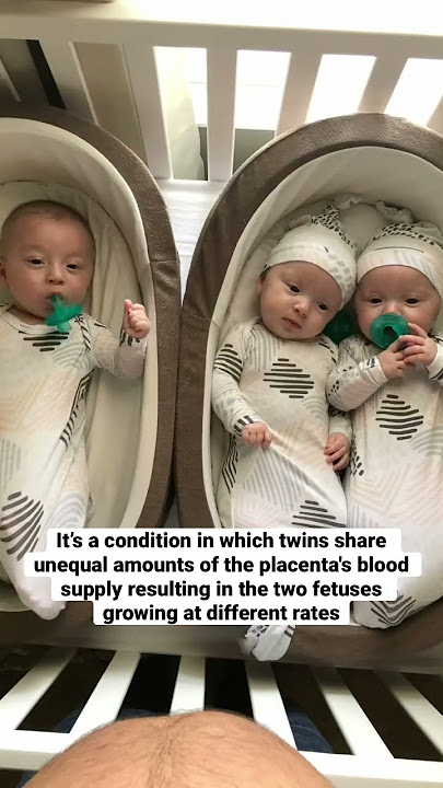 Why the doctor recommended termination of one of the triplets. The explanation. #shorts #triplets