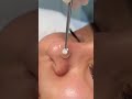 #PimplePixy #AcneClean #SatisfyingExtraction #PimplePopping #skincareasmr