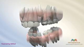 Orthodontic Treatment for Severe Crowding - Serial Extraction