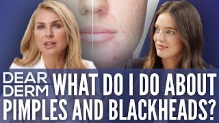 What do I do about pimples and blackheads Emily DiDonato & Dr. Julie Russak | Model Skincare