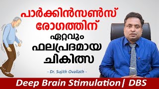 പാർക്കിൻസൺസ് രോഗത്തിന് ഏറ്റവും ഫലപ്രദമായ ചികിത്സ | Parkinson's Disease Treatment | DBS