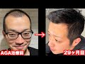 ハゲた友達にAGA治療薬飲ませてみたw【29ヶ月目】