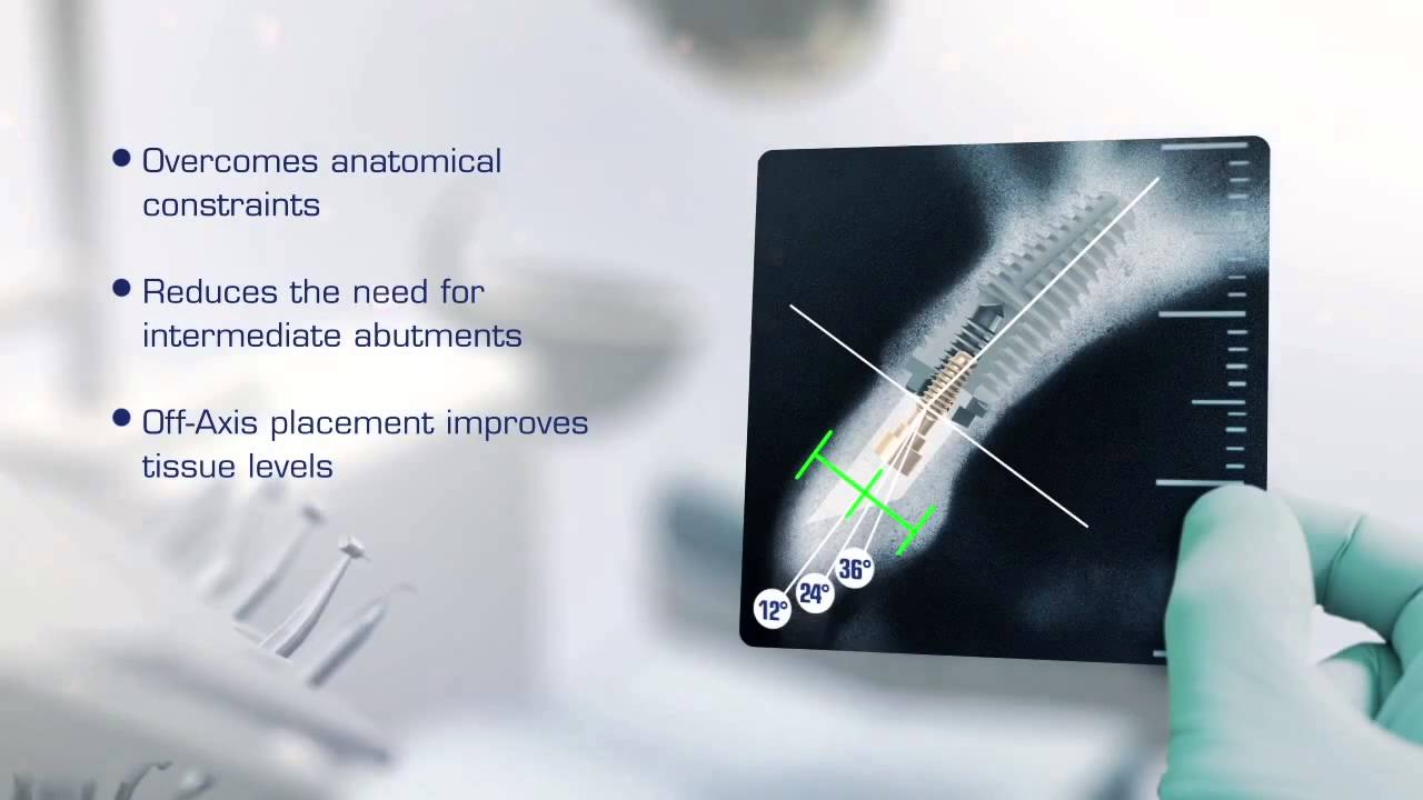 Southern Implants YouTube