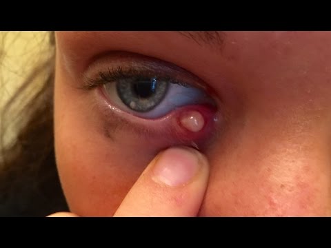 How To Treat A Stye On The Eye - Natural Remedy for Eye Stye.