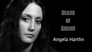 'Scars of Shame'  Trailer (Dermatillomania)