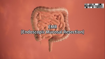 The basic steps of EMR(Endoscopic Mucosal Resection) surgery
