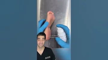 Screw Removal from Foot