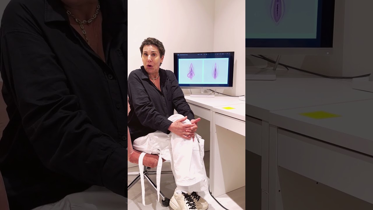 Non surgical Labiaplasy, Before and After