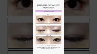 뒤트임부작용(ㄷ자모양)이 왔다면 (+앞트임복원) #시선성형외과 #shorts