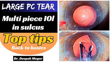 My top tips for placing a Multipiece IOL in Sulcus in the event of a large PC Tear - Back to basics