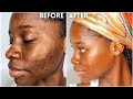 How I cleared my 8 years ACNE & HYPERPIGMENTATION | How I got rid of textured skin & got GLASS SKIN