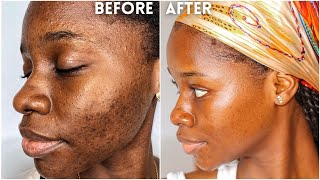 How I cleared my 8 years ACNE & HYPERPIGMENTATION | How I got rid of textured skin & got GLASS SKIN