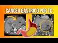 TC de Cáncer Gástrico: Guía Completa de Hallazgos y Diferenciales