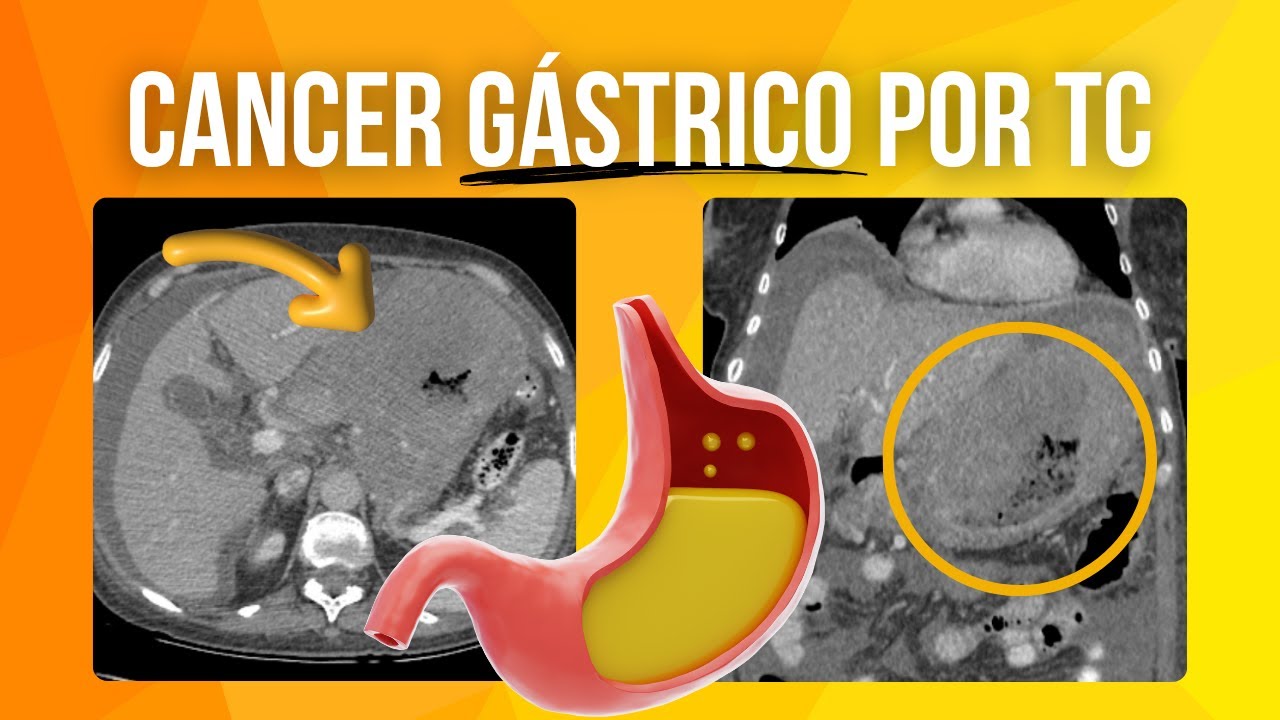 TC de Cáncer Gástrico: Guía Completa de Hallazgos y Diferenciales