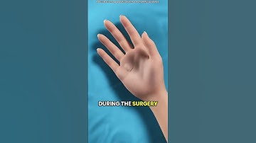Trigger finger release surgery 3D animation   knowledgebureau