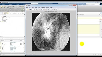 Secondary Glaucoma Diagnosis Technique || IEEE 2017 Matlab Projects in Bangalore