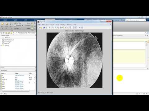 Secondary Glaucoma Diagnosis Technique || IEEE 2017 Matlab Projects in Bangalore