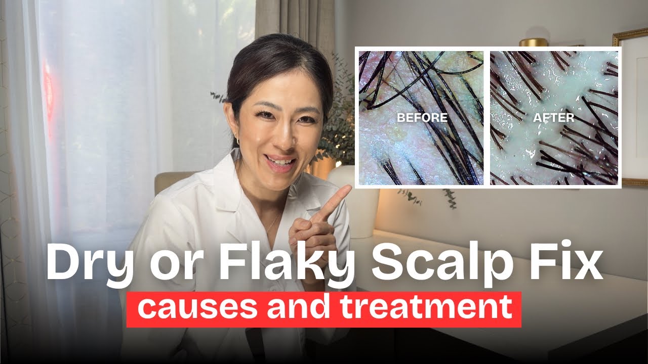 Dry or Flaky scalp ? Causes and treatment 