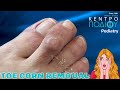 Dorsal corns removal|Αφαίρεση τύλων|Κέντρο Ποδιού|Podiatry|Podiatrist|Podologia|Podologa|Foot|Feet