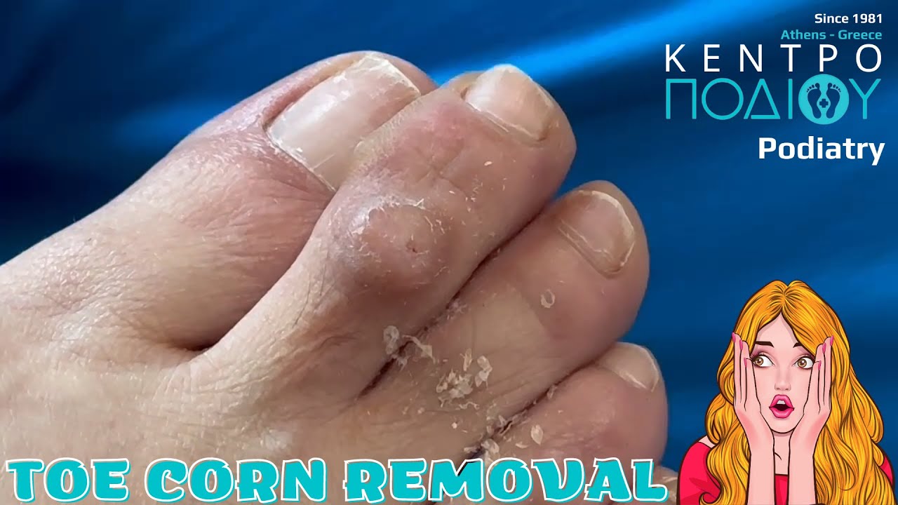 Dorsal corns removal|Αφαίρεση τύλων|Κέντρο Ποδιού|Podiatry|Podiatrist ...