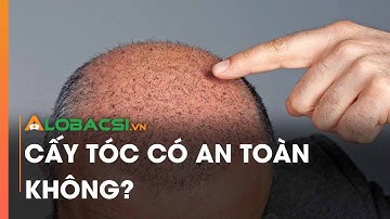 Cấy tóc có an toàn không?