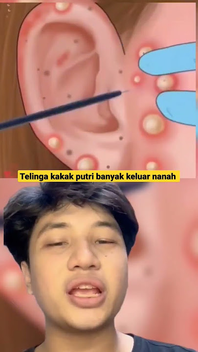 TELINGA KAKAK PUTRI BANYAK KELUAR NANAH #viral #shortsviral