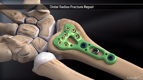 Distal Radius Fracture Repair