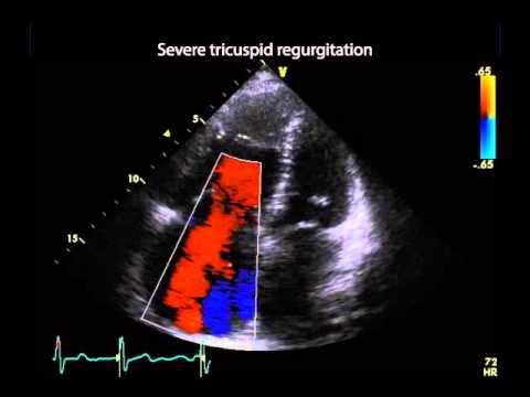 Video: Tricuspid Valve Dysplasi hos hunder og katter