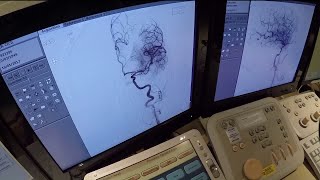 Knowing the signs of Stroke Can Save a Life