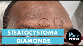 Dr Pimple Popper Mines For Steatocystoma Diamonds! 💎