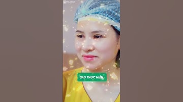 Mí xinh lung linh sau 30 phút cắt mí A.I Nano Matrix Deep tại Dr.Hải Lê