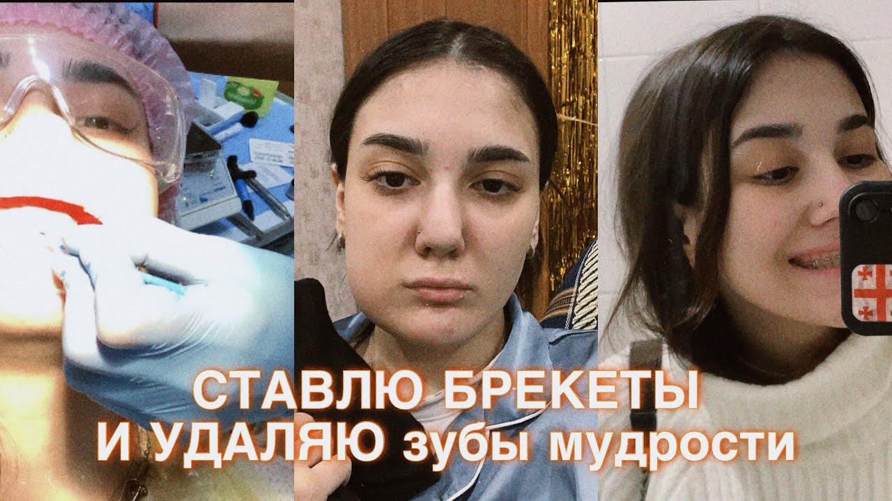 Я ПОСТАВИЛА БРЕКЕТЫ 😍