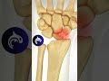 Scaphoid Fracture Surgery 4K 3D Medical Animation 