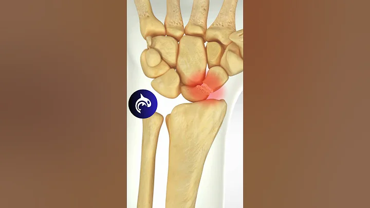 Scaphoid Fracture Surgery | 4K 3D Medical Animation