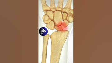 Scaphoid Fracture Surgery | 4K 3D Medical Animation