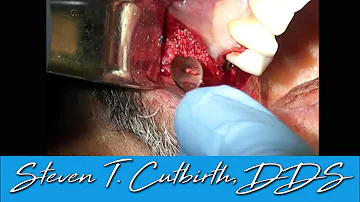 Can cadaver bone be rejected?